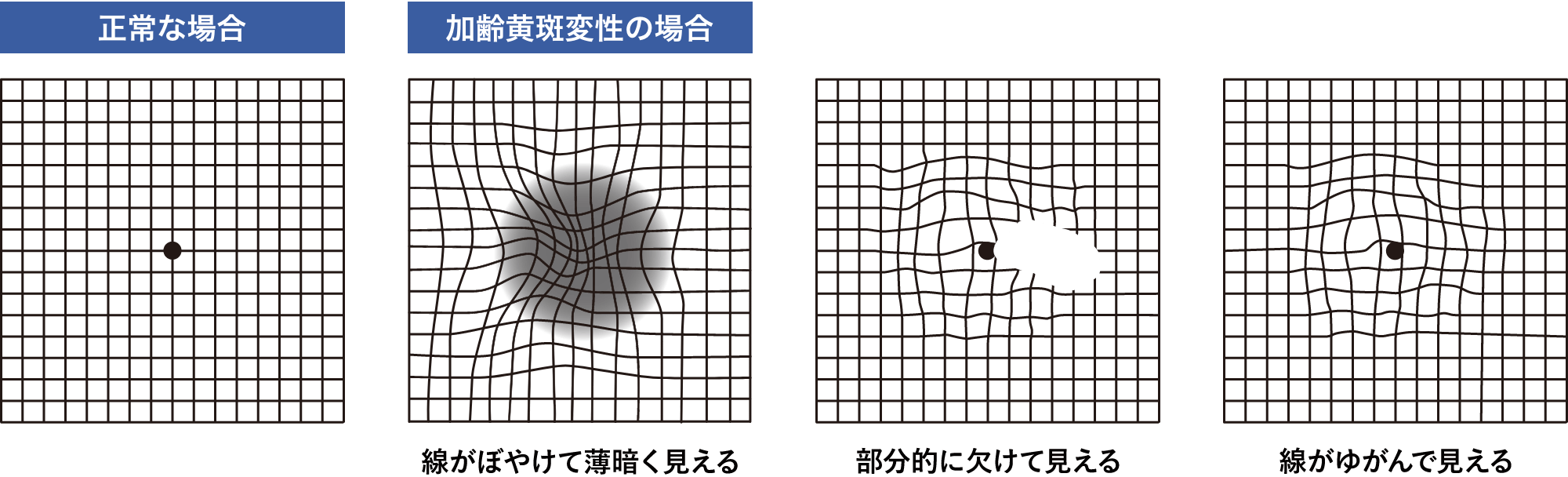 正常な場合 加齢黄斑変性症の場合