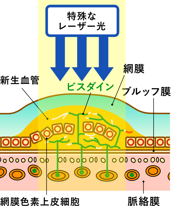 光線力学療法