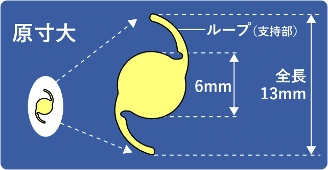眼内レンズとは？