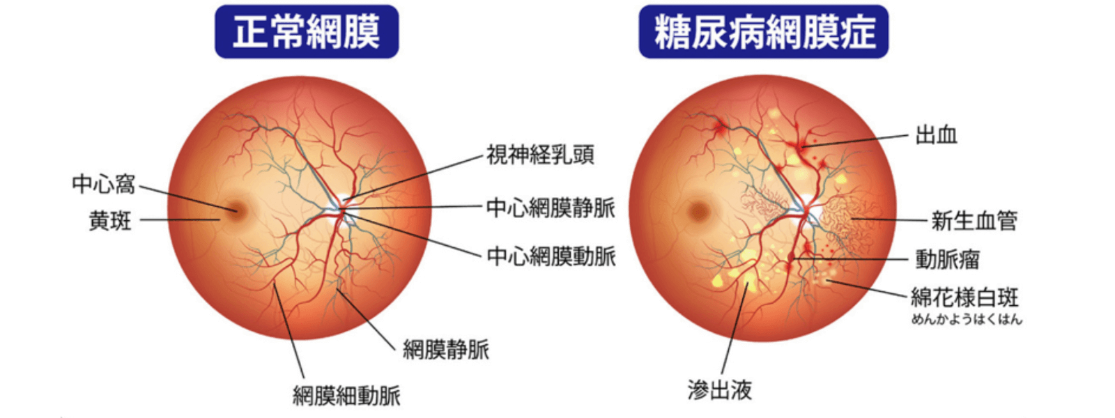 正常網膜 糖尿病網膜