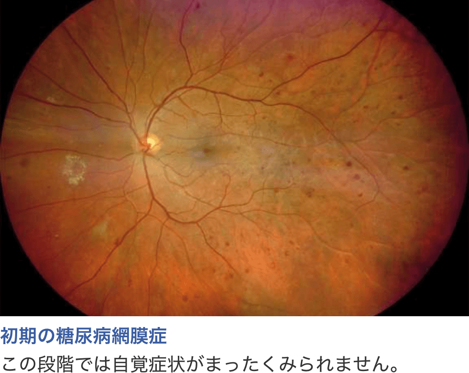 初期の糖尿病網膜症