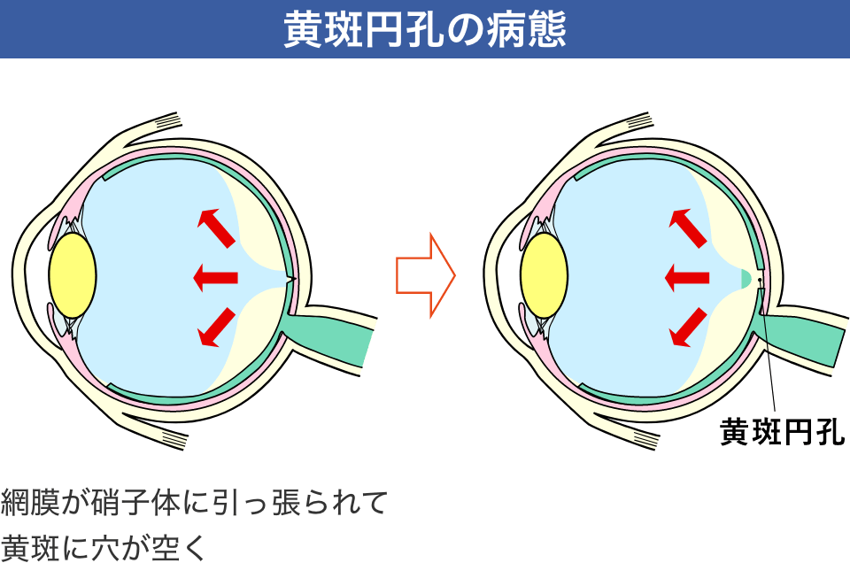 黄斑円孔の病態
