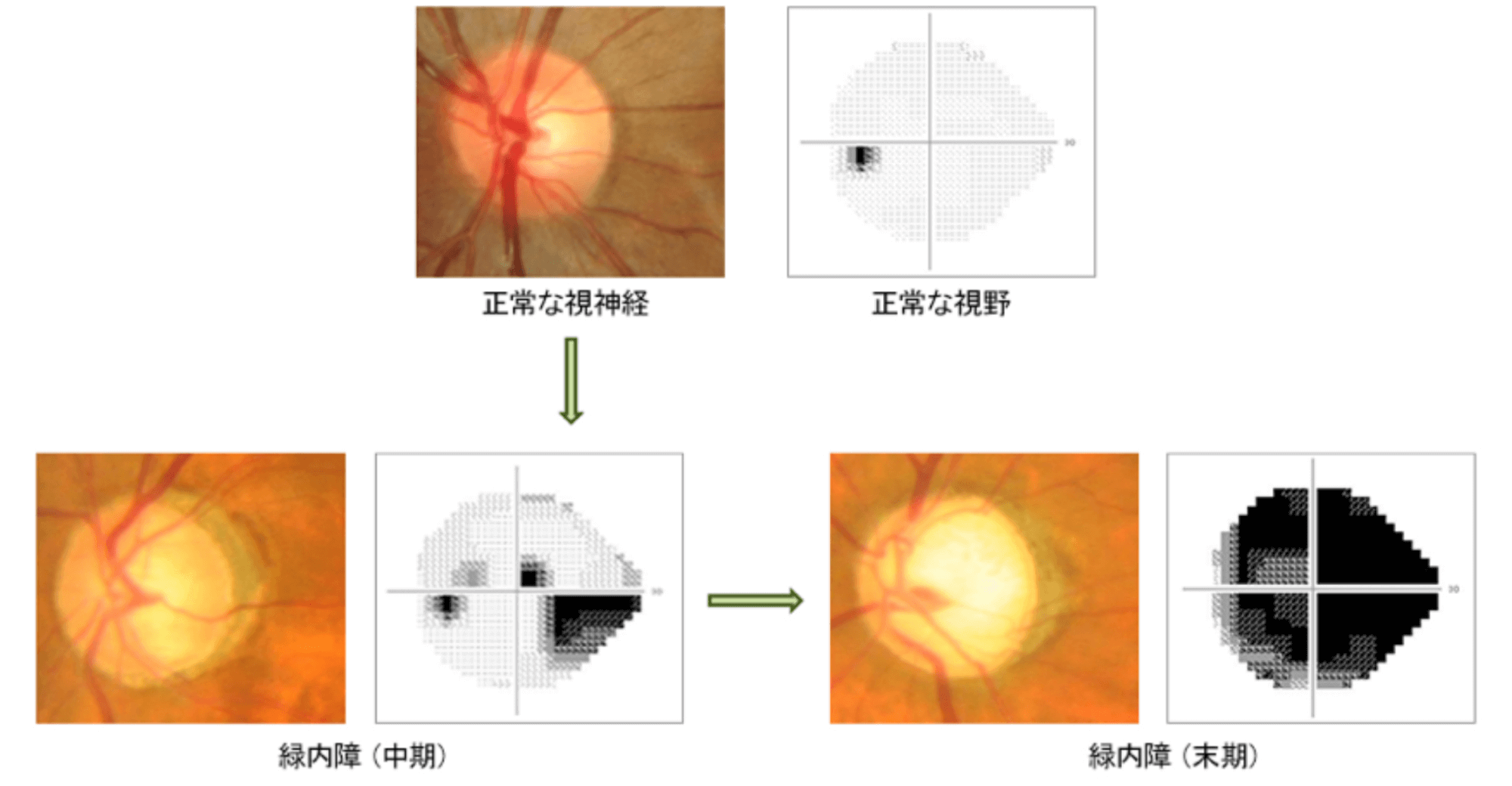 正常な視神経 正常な視野 緑内障(中期) 緑内障(末期)