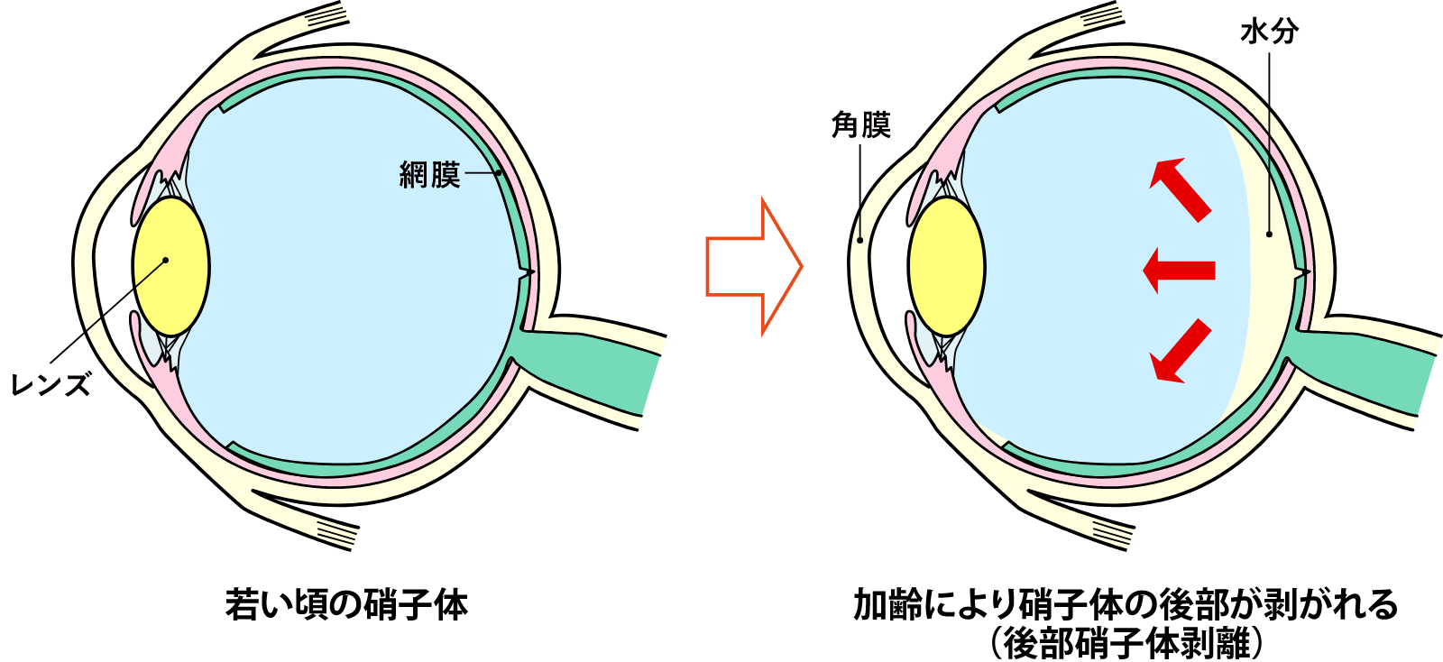 後部硝子体剥離