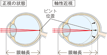 正規の状態 軸性近視