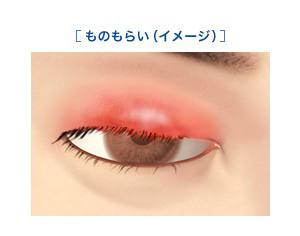 麦粒腫とは