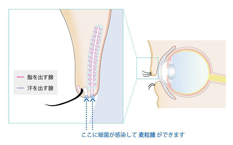麦粒腫の治療