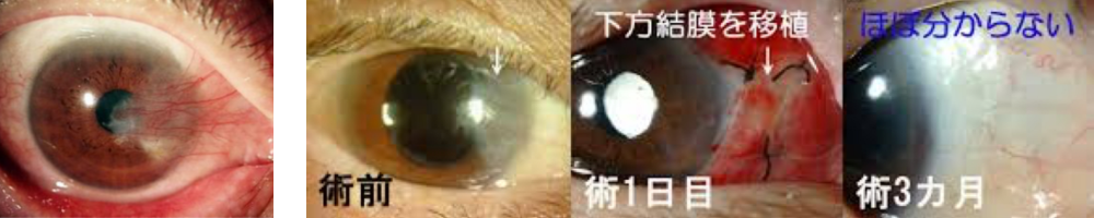 翼状片切除術2